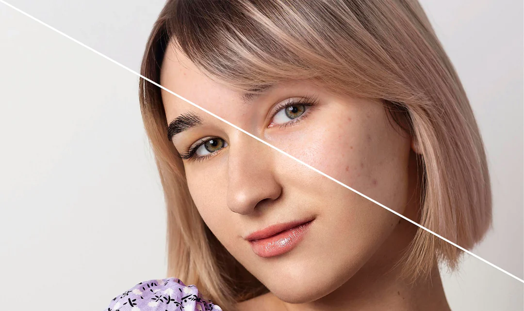 Hiperpigmentacija kože: kako umanjiti pege i fleke i postići ujednačen ten? 6 Blog slike 10